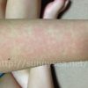 りんご病は一生に一度だけかかるの？何日で治る？出席停止の期間は？